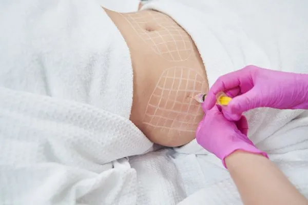 image of fat dissolving injections on love handles to help combat weight gain Waltham Forest