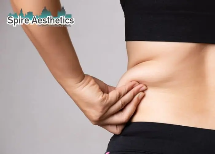 Image of woman pinching fat on their hips Waltham Forest. Fat Freezing treatment