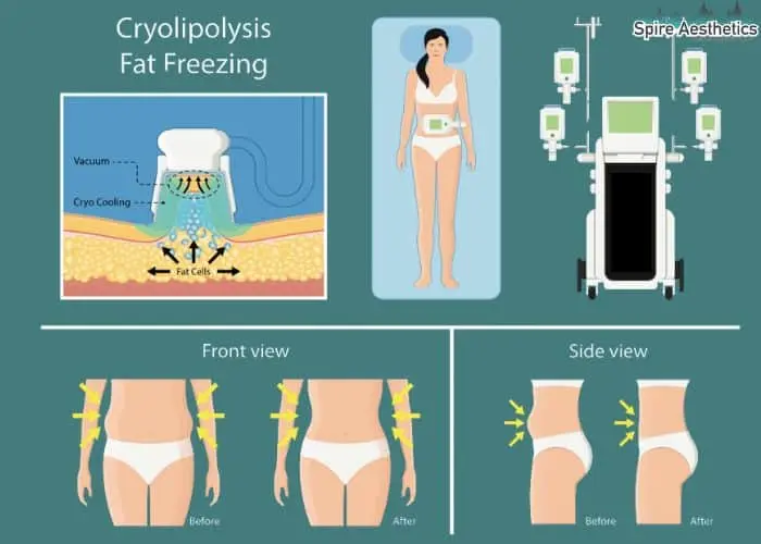 Fat freezing treatment Waltham Forest benefits for competitions to remove stubborn fat deposits.
