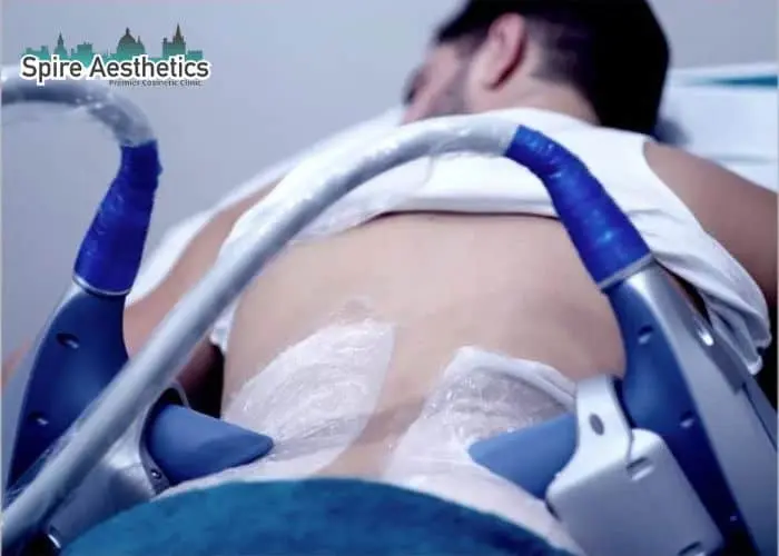 Man having fat freezing treatment done on love handles before a competitions Waltham Forest to create a sculpted look.