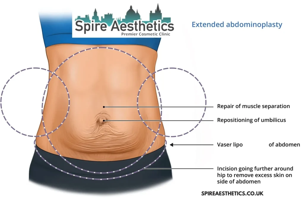Understanding Loose Skin After Gastric Band Waltham Forest Surgery and HIFU Treatment