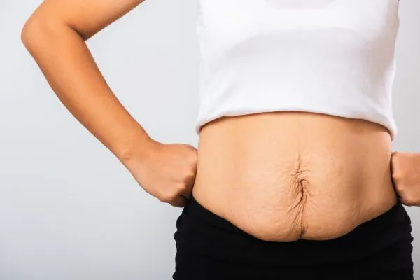 Image of a woman's stomach after weight loss with sagging skin following a gastric band Waltham Forest