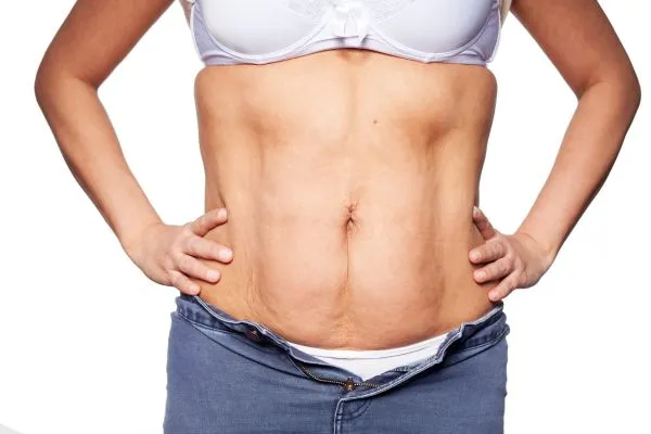 sagging skin on woman's stomach after weight loss injections Waltham Forest