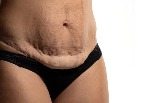 Image of womans stomach after weight loss injections Waltham Forest showing saggy skin