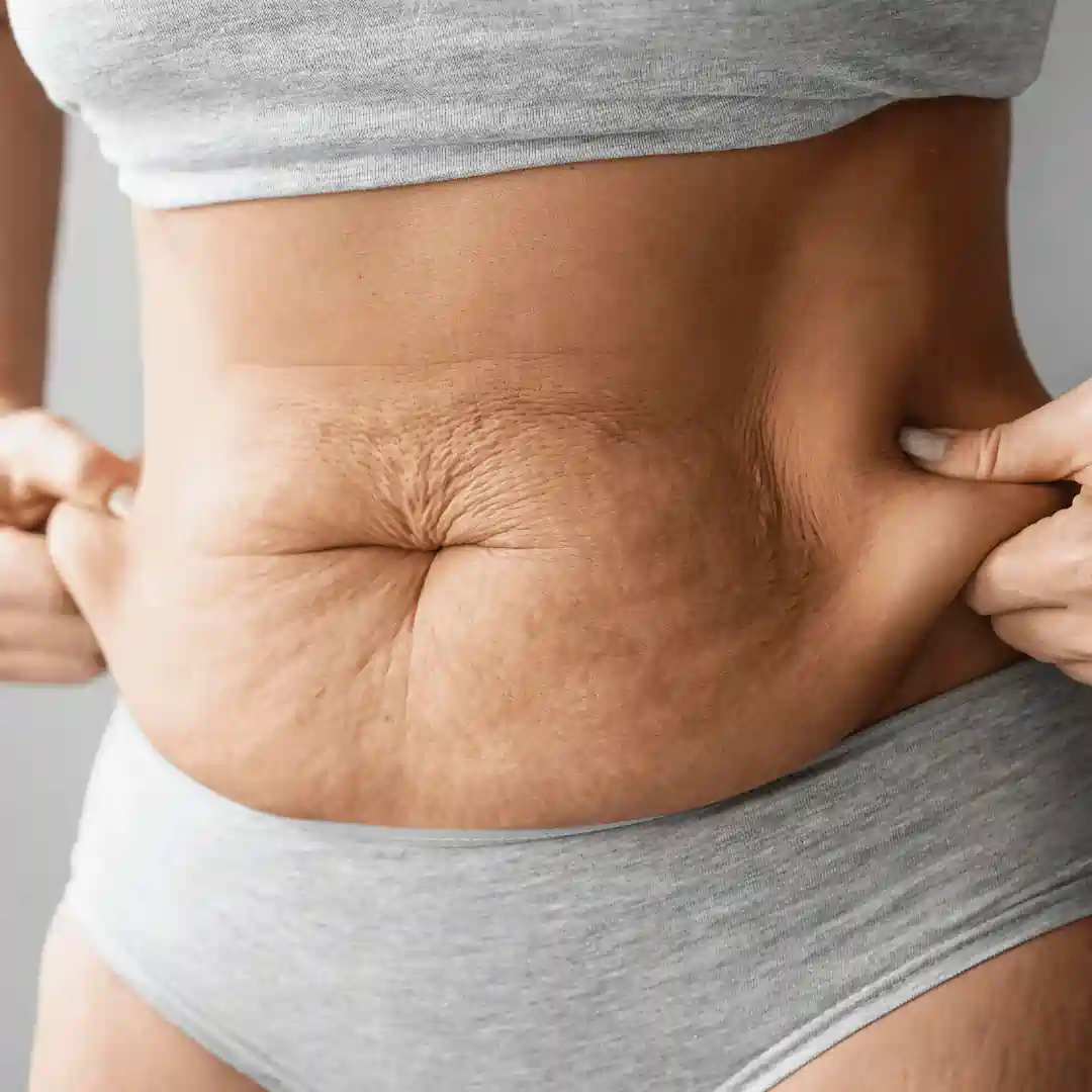 Is It Normal to Have Loose Skin After Pregnancy Waltham Forest?