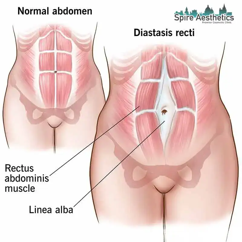 When Will My Belly Feel Normal Again Waltham Forest?