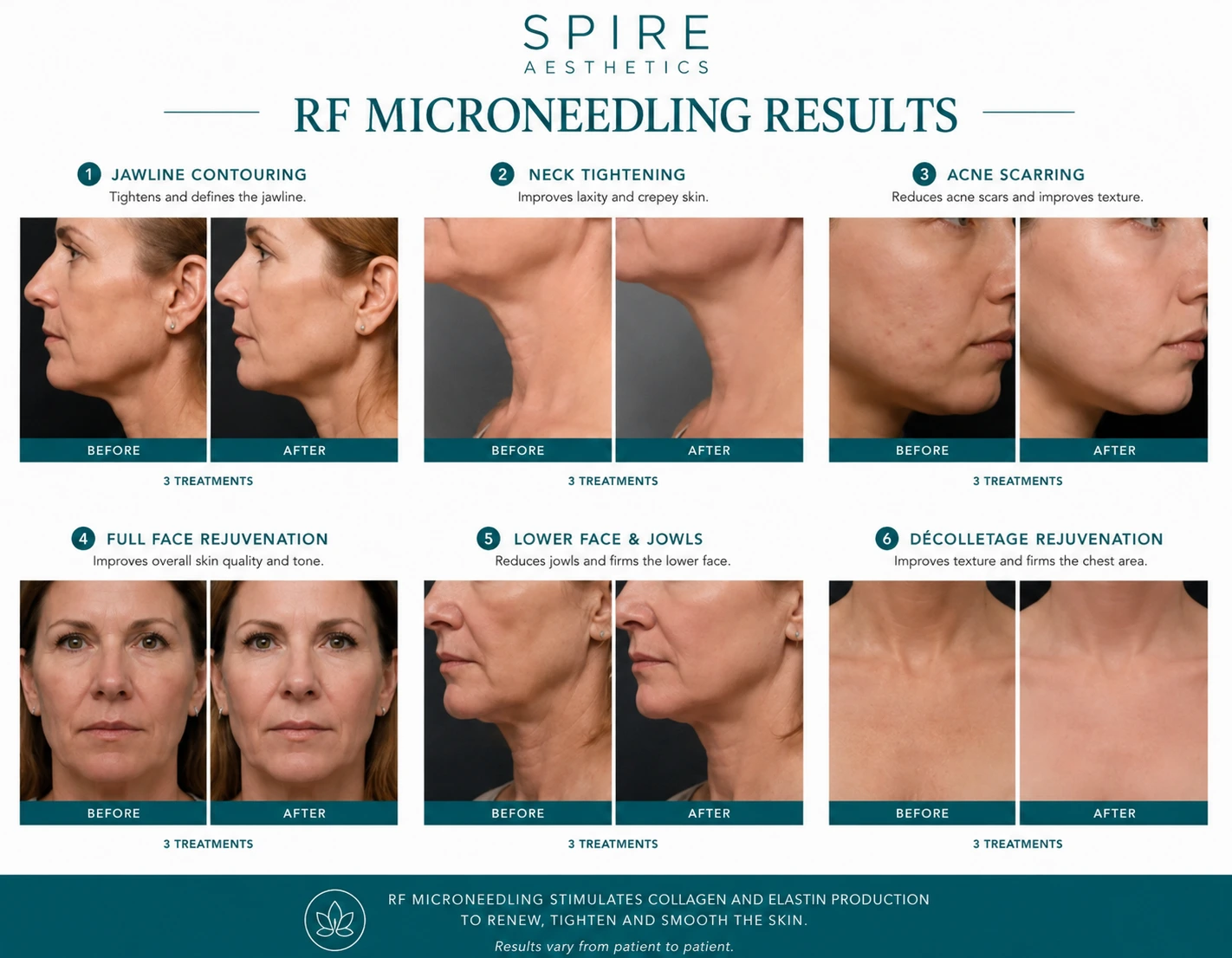 RF Microneedling Skin tightening Waltham Forest results