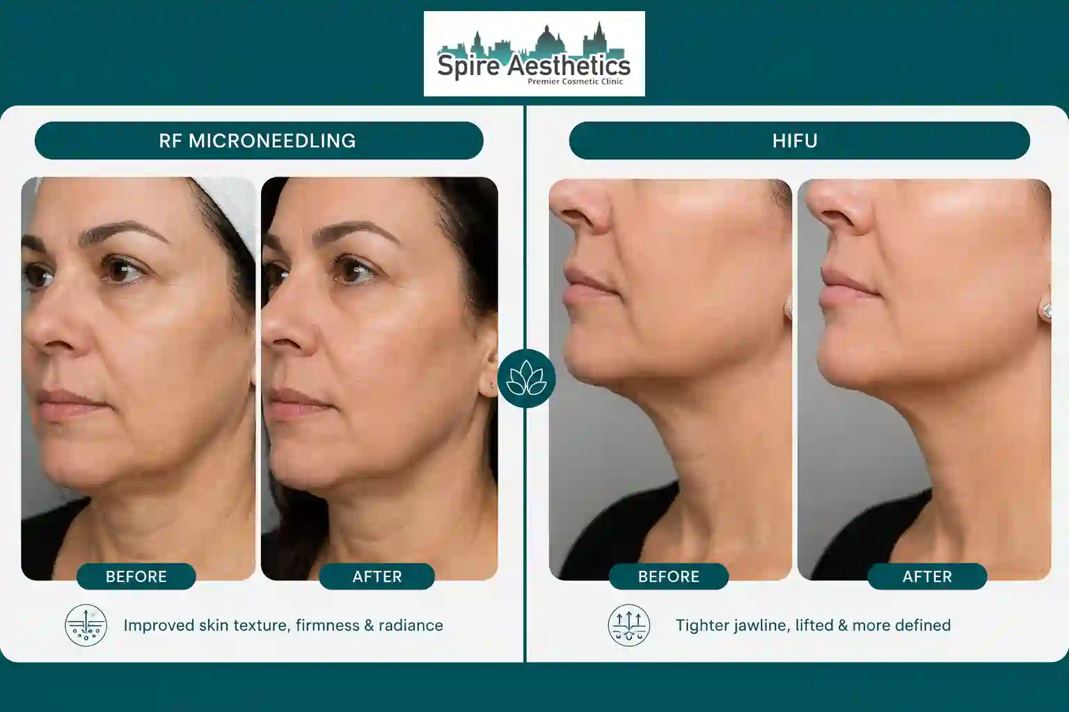 Can RF Microneedling and HIFU Be Combined Waltham Forest?