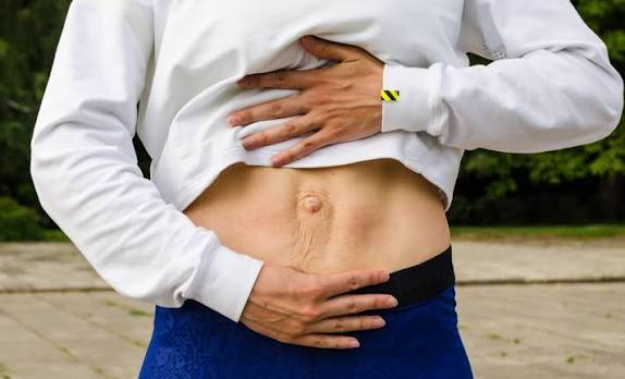When Could Diastasis Recti Be the Missing Piece of the Puzzle Waltham Forest?