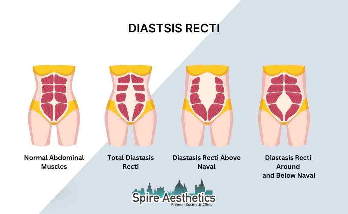 Is Non-Surgical Diastasis Recti Treatment Right for You? Common Concerns Answered Waltham Forest